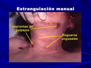 Estrangulación manual 
Regueros 
ungueales 
Improntas de 
pulpejos 
 