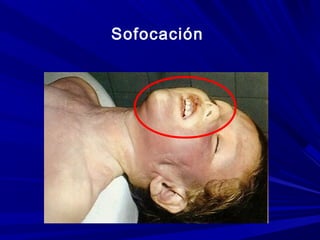 Sofocación 
 