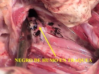 NEGRO DE HUMO EN TRAQUEA 
 