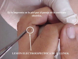 Es la impronta en la piel por el pasaje de la corriente 
eléctrica. 
LESIÓN ELECTROESPECÍFICA DE JELLINEK 
 
