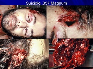 SSuuiicciiddiioo ..335577 MMaaggnnuumm 
 