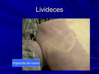 LLiivviiddeecceess 
Impronta de mano 
 