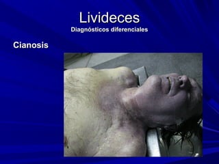 LLiivviiddeecceess 
DDiiaaggnnóóssttiiccooss ddiiffeerreenncciiaalleess 
CCiiaannoossiiss 
 