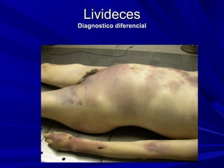 LLiivviiddeecceess 
DDiiaaggnnoossttiiccoo ddiiffeerreenncciiaall 
 