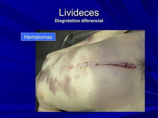 LLiivviiddeecceess 
DDiiaaggnnóóssttiiccoo ddiiffeerreenncciiaall 
Hematomas 
 