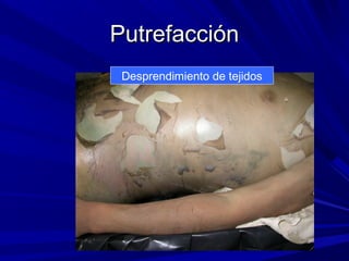 PPuuttrreeffaacccciióónn 
Desprendimiento de tejidos 
 