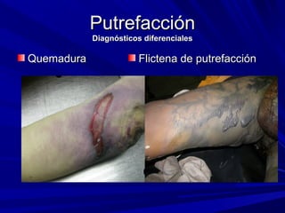 PPuuttrreeffaacccciióónn 
DDiiaaggnnóóssttiiccooss ddiiffeerreenncciiaalleess 
QQuueemmaadduurraa FFlliicctteennaa ddee ppuuttrreeffaacccciióónn 
 