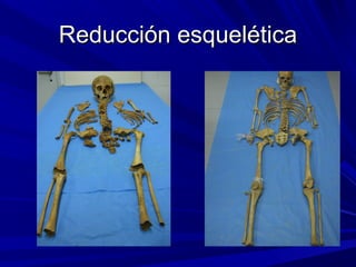 RReedduucccciióónn eessqquueellééttiiccaa 
 