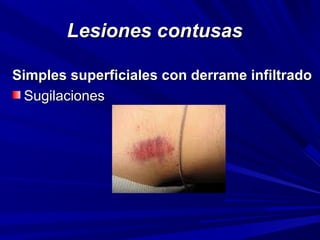 LLeessiioonneess ccoonnttuussaass 
SSiimmpplleess ssuuppeerrffiicciiaalleess ccoonn ddeerrrraammee iinnffiillttrraaddoo 
SSuuggiillaacciioonneess 
 