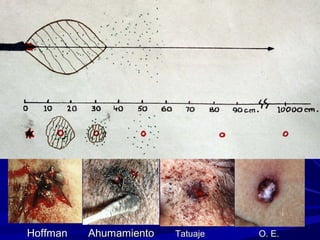 DDiissttaanncciiaa ddee ddiissppaarroo 
DDiiaaggnnóóssttiiccoo mmééddiiccoo lleeggaall 
HHooffffmmaann AAhhuummaammiieennttoo TTaattuuaajjee OO.. EE.. 
 