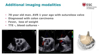 Additional imaging modalities
• 78 year old man. AVR 1 year ago with sutureless valve
• Diagnosed with colon carcinoma
• Fever, loss of weight
• TTE -, blood cultures -
 