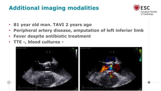 Additional imaging modalities
• 81 year old man. TAVI 2 years ago
• Peripheral artery disease, amputation of left inferior limb
• Fever despite antibiotic treatment
• TTE -, blood cultures -
 
