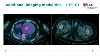 Additional imaging modalities – PET-CT
 
