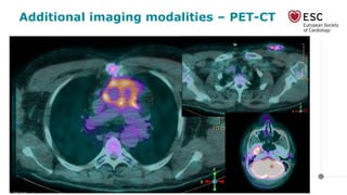 Additional imaging modalities – PET-CT
 