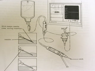 Escharotomy | PPT