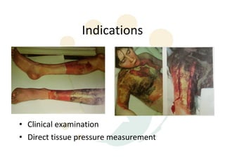 Indications




• Clinical examination
• Direct tissue pressure measurement
 