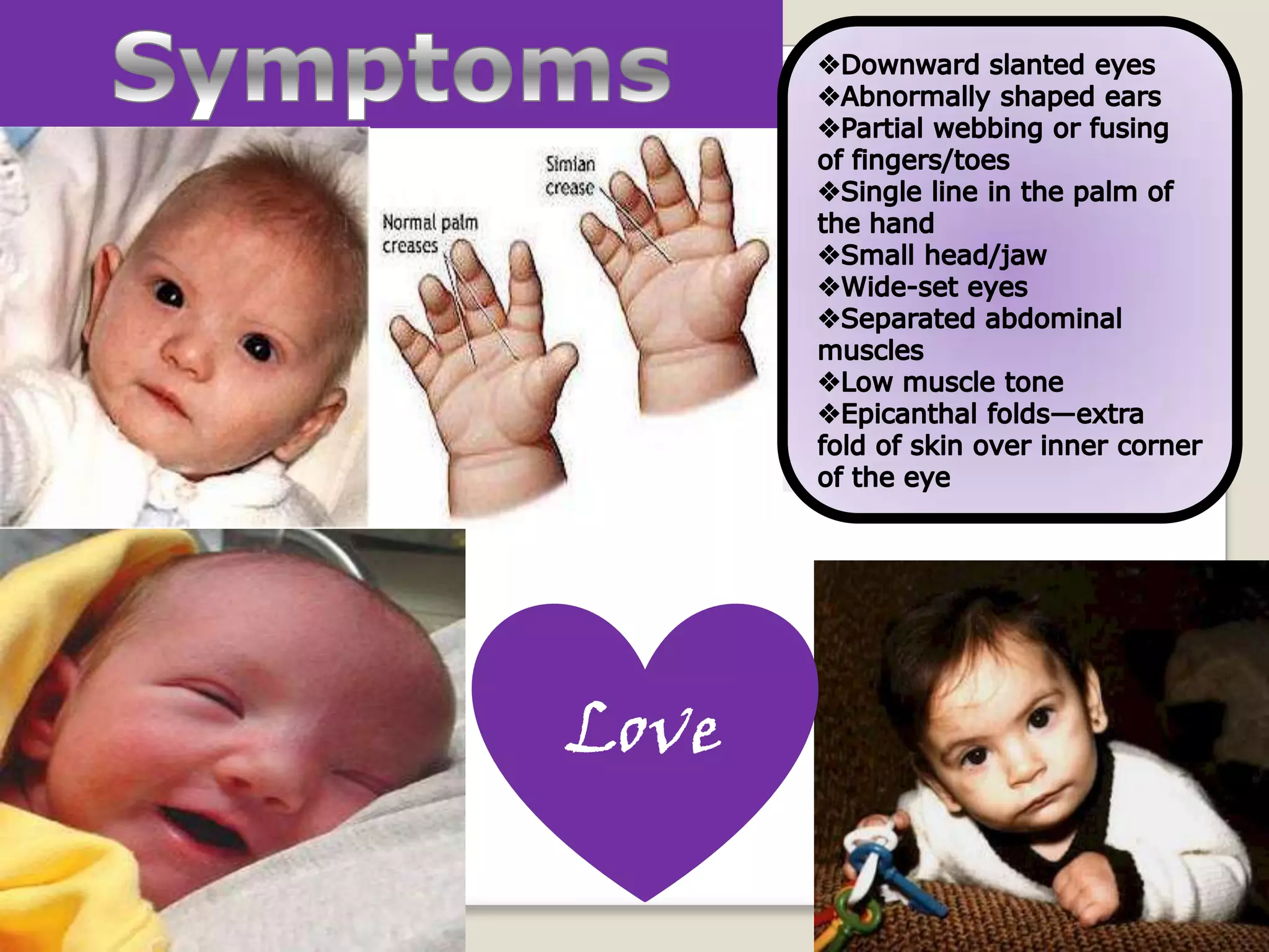 Cri Du Chat Syndrome