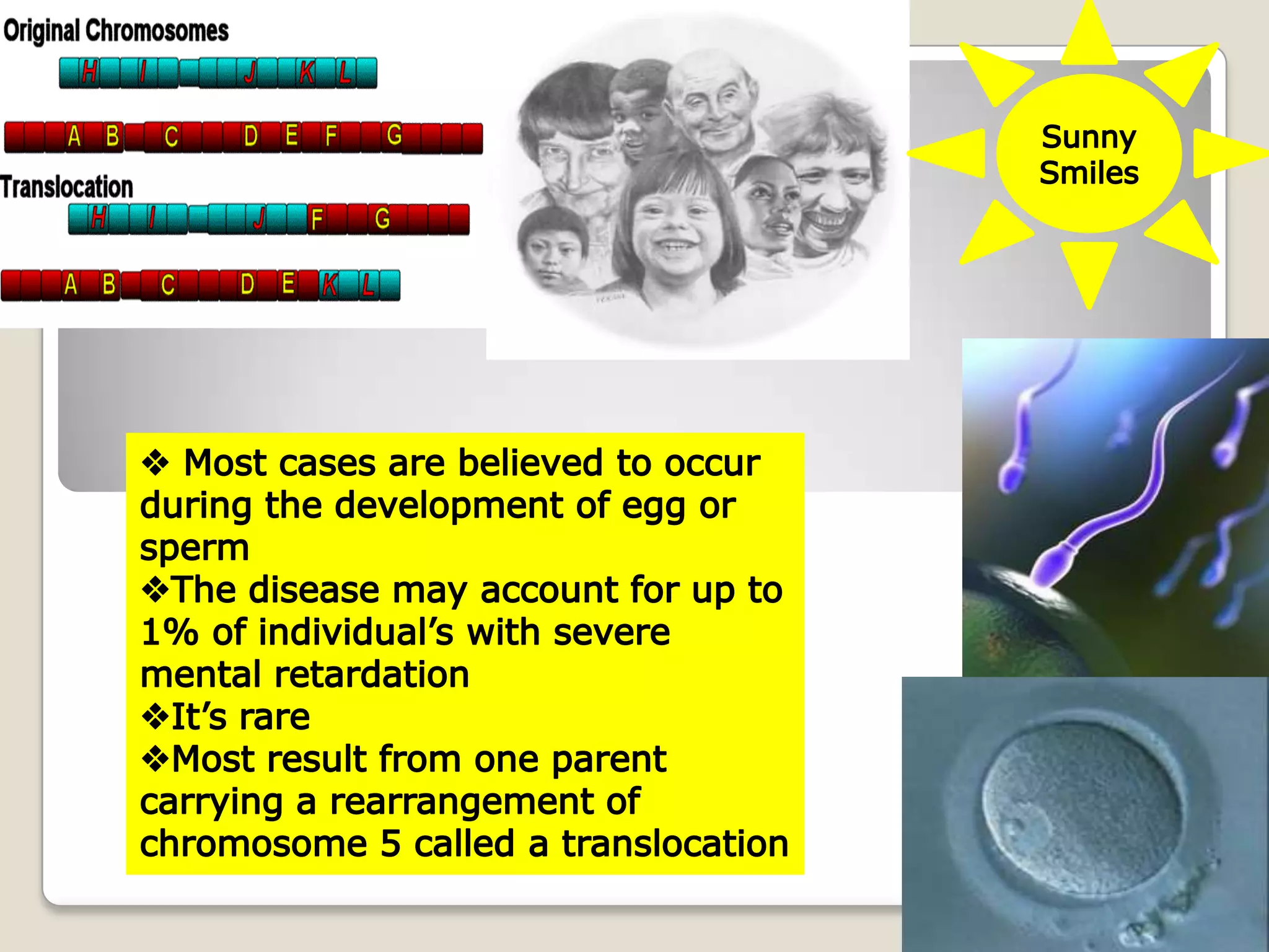 Cri Du Chat Syndrome