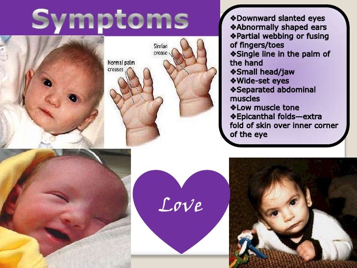 Cri Du Chat Syndrome