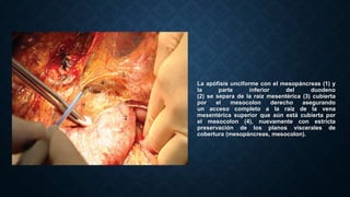 La apófisis unciforme con el mesopáncreas (1) y
la parte inferior del duodeno
(2) se separa de la raíz mesentérica (3) cubierta
por el mesocolon derecho asegurando
un acceso completo a la raíz de la vena
mesentérica superior que aún está cubierta por
el mesocolon (4), nuevamente con estricta
preservación de los planos viscerales de
cobertura (mesopáncreas, mesocolon).
 