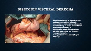 DISECCION VISCERAL DERECHA
El colon derecho, el duodeno con
cabeza pancreática y la raíz
mesentérica están completamente
movilizados y el plano mesentérico
sobre el páncreas y el
mesenterio separado del plano
parietal que cubre los órganos
retroperitoneales
incluyendo la vena cava (1) y la
aorta (2).
 