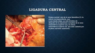 LIGADURA CENTRAL
Enlace central: raíz de la vena ileocólica (1); la
arteria correspondiente, que
cruza desde abajo, ya está dividida (2)
después de la exposición completa de la vena
mesentérica superior (3) y la arteria
mesentérica superior (4), que está cubierta por
el plexo nervioso autónomo.
 