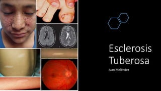 Esclerosis
Tuberosa
Juan Meléndez
 