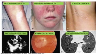 MÁCULAS HIPOMELANÓTICAS. ANGIOFIBROMAS FACIALES. PLACA DE CHAGRÍN
RABDOMIOMA HIPERECOICO HAMARTOMA RETINIANO LINFANGIOLEIOMIOMATOSIS
Nelson WKliegman R. Tratado de pediatría [de] Nelson. 20th ed. Barcelona: Elsevier; 2015.
 