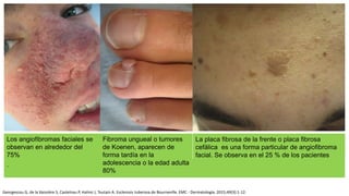 .
La placa fibrosa de la frente o placa fibrosa
cefálica es una forma particular de angiofibroma
facial. Se observa en el 25 % de los pacientes
Fibroma ungueal o tumores
de Koenen, aparecen de
forma tardía en la
adolescencia o la edad adulta
80%
Los angiofibromas faciales se
observan en alrededor del
75%
Georgescou G, de la Vaissière S, Castelnau P, Halimi J, Toutain A. Esclerosis tuberosa de Bourneville. EMC - Dermatología. 2015;49(3):1-12.
 