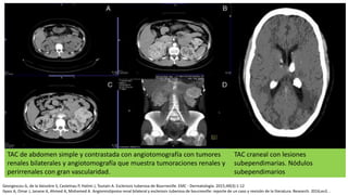 TAC de abdomen simple y contrastada con angiotomografía con tumores
renales bilaterales y angiotomografía que muestra tumoraciones renales y
perirrenales con gran vascularidad.
Georgescou G, de la Vaissière S, Castelnau P, Halimi J, Toutain A. Esclerosis tuberosa de Bourneville. EMC - Dermatología. 2015;49(3):1-12
Ilyass A, Omar J, Janane A, Ahmed A, Mohamed A. Angiomiolipoma renal bilateral y esclerosis tuberosa de bourneville: reporte de un caso y revisión de la literatura. Research. 2016;es3. .
TAC craneal con lesiones
subependimarias. Nódulos
subependimarios
 