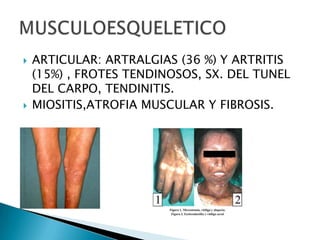    ARTICULAR: ARTRALGIAS (36 %) Y ARTRITIS
    (15%) , FROTES TENDINOSOS, SX. DEL TUNEL
    DEL CARPO, TENDINITIS.
   MIOSITIS,ATROFIA MUSCULAR Y FIBROSIS.
 