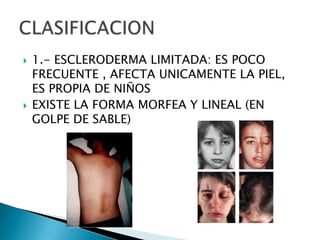    1.- ESCLERODERMA LIMITADA: ES POCO
    FRECUENTE , AFECTA UNICAMENTE LA PIEL,
    ES PROPIA DE NIÑOS
   EXISTE LA FORMA MORFEA Y LINEAL (EN
    GOLPE DE SABLE)
 