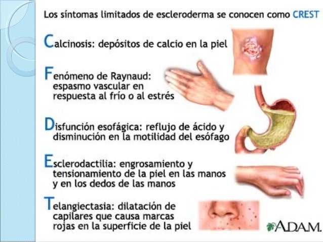 La eccema el tratamiento por el medio público