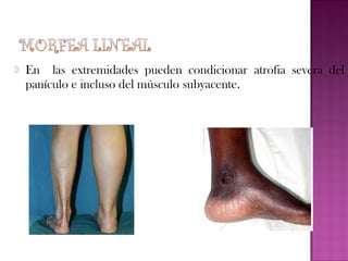 

En las extremidades pueden condicionar atrofia severa del
panículo e incluso del músculo subyacente.

 
