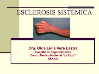ESCLEROSIS SISTÉMICA
Dra. Olga Lidia Vera Lastra
Hospital de Especialidades
Centro Médico Nacional “La Raza”
MÉXICO
 