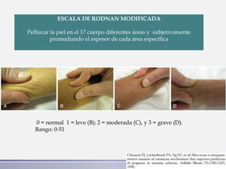 Rodnan Scale Esclerodermia | PPTX