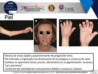 Piel
Fibrosis de inicio rápido y posteriormente de progresión lenta.
Piel indurada y engrosada con disminución de los pliegues y ausencia de vello.
Cambios en apariencia facial; prurito, alteraciones en la pigmentación. Lesiones
“sal y pimienta”.
Limitación de movilidad de articulaciones debido a involucro cutáneo.
CP Denton, D Khanna Systemic sclerosis. The Lancet. April 13, 2017. http://dx.doi.org/10.1016/S0140-6736(17)30933-9
Dra. De Lira
CRAIC Mty
 