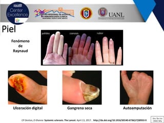 Piel
CP Denton, D Khanna Systemic sclerosis. The Lancet. April 13, 2017. http://dx.doi.org/10.1016/S0140-6736(17)30933-9
palidez cianosis rubor
Ulceración digital Gangrena seca Autoamputación
Fenómeno
de
Raynaud
Dra. De Lira
CRAIC Mty
 