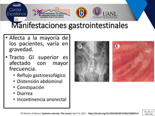 Manifestaciones gastrointestinales
• Afecta a la mayoría de
los pacientes, varía en
gravedad.
• Tracto GI superior es
afectado con mayor
frecuencia.
• Reflujo gastroesofágico
• Distensión abdominal
• Constipación
• Diarrea
• Incontinencia anorectal
CP Denton, D Khanna Systemic sclerosis. The Lancet. April 13, 2017. http://dx.doi.org/10.1016/S0140-6736(17)30933-9
Dra. De Lira
CRAIC Mty
 
