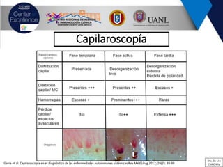 Garra et al. Capilaroscopía en el diagnóstico de las enfermedades autoinmunes sistémicas Rev Méd Urug 2012; 28(2): 89-98
Capilaroscopía
Dra. De Lira
CRAIC Mty
 