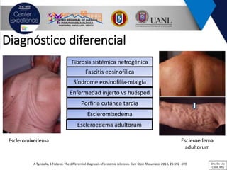 Diagnóstico diferencial
A Tyndalla, S Fistarol. The differential diagnosis of systemic sclerosis. Curr Opin Rheumatol 2013, 25:692–699
Escleromixedema Escleroedema
adultorum
Fibrosis sistémica nefrogénica
Fascitis eosinofílica
Síndrome eosinofilia-mialgia
Enfermedad injerto vs huésped
Porfiria cutánea tardía
Escleromixedema
Escleroedema adultorum
Dra. De Lira
CRAIC Mty
 