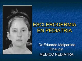 ESCLERODERMIA
ESCLERODERMIA
EN PEDIATRIA
EN PEDIATRIA
Dr.Eduardo Malpartida
Dr.Eduardo Malpartida
Chaupin
Chaupin
MEDICO PEDIATRA.
MEDICO PEDIATRA.
 