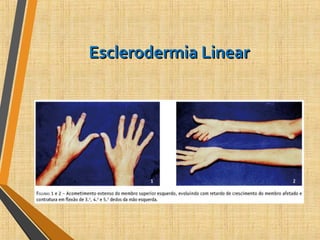 Esclerodermia LinearEsclerodermia Linear
 