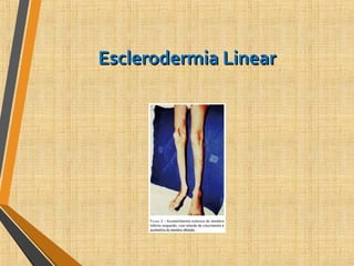 Esclerodermia LinearEsclerodermia Linear
 