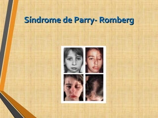 Síndrome de Parry- RombergSíndrome de Parry- Romberg
 