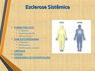 Esclerose SistêmicaEsclerose Sistêmica
• FORMA PRECOCE
• F. Raynaud
• Capilaroscopia SD
• ACA ou SCl-70 +
• SINE ESCLERODERMA
• F. Raynaud
• FAN positivo
• Manifestações viscerais
• LIMITADA
• DIFUSA
• SÍNDROMES DE SUPERPOSIÇÃO
 