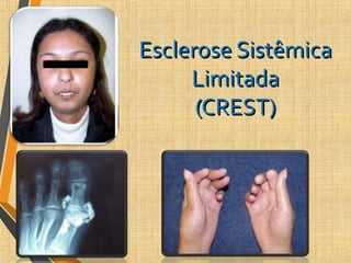 Esclerose SistêmicaEsclerose Sistêmica
LimitadaLimitada
(CREST)(CREST)
 