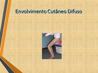 Envolvimento Cutâneo DifusoEnvolvimento Cutâneo Difuso
 