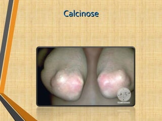 CalcinoseCalcinose
 
