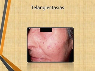 TelangiectasiasTelangiectasias
 